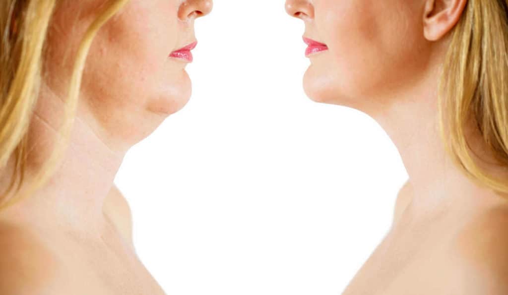 Double Chin treatment Ruislip Manor before and after results