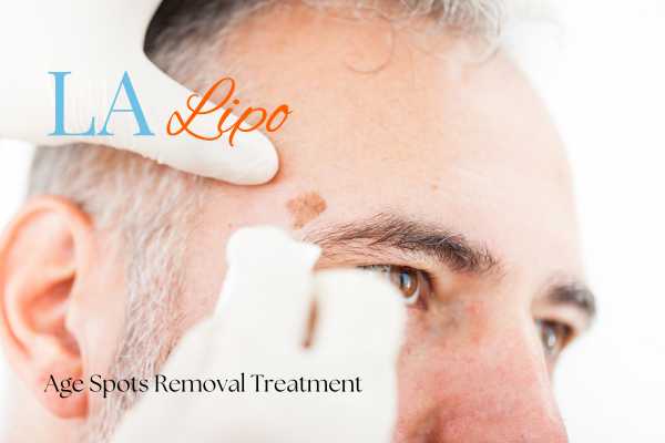 What Are the Most Effective Treatments for Age Spots Ruislip Manor?