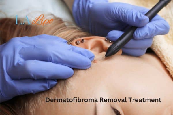 Dermatofibroma Removal Treatment Ruislip Manor