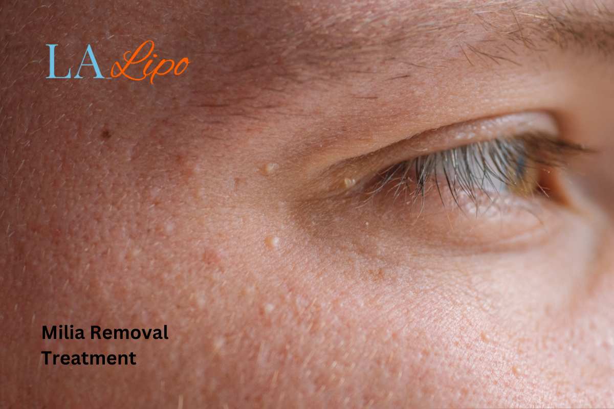 Cryopen Milia Removal: Is It the Easiest and Safest Option Ruislip Manor?