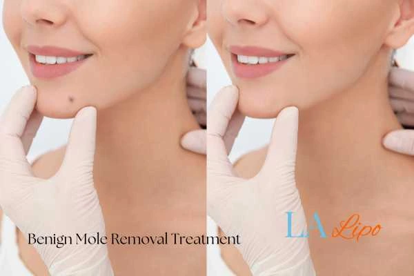 woman's before and after mole removal Ruislip Manor results