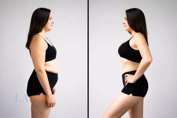 image of woman before and after results of LA-EMS Body Sculpting Ruislip Manor to help treat Diastasis recti