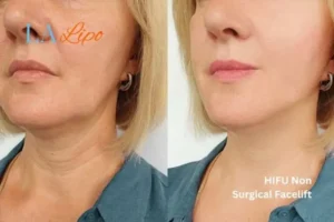 hi-fu for wrinkles Ruislip Manor before and after results