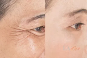Before and after results of woman - HI-fu wrinkles reduction treatment Ruislip Manor