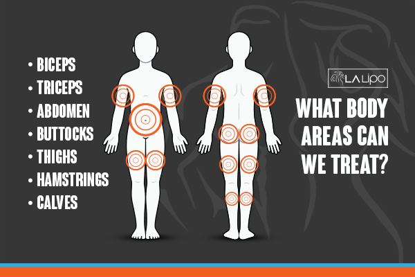 Graphic to show areas you can have LA-EMS Body Sculpting Ruislip Manor treatment.