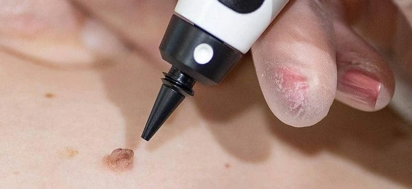 skin tag removal using cryopen Ruislip Manor