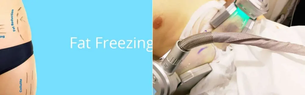 Fat freezing Ruislip Manor on multiple areas of the body