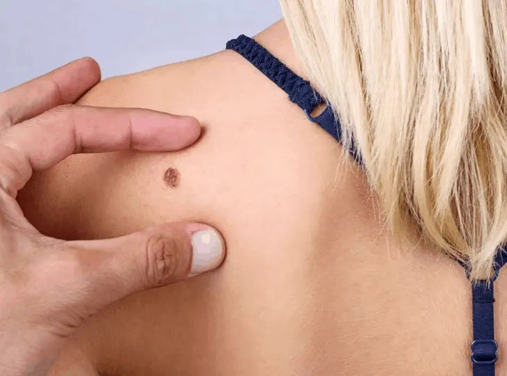 woman having mole removal Ruislip Manor consultation before treatment.