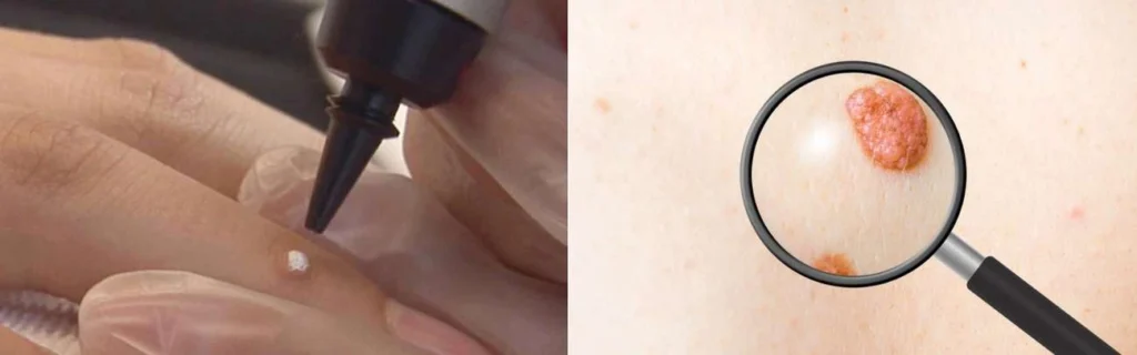 CryoPen practitioner Ruislip Manor assessing a benign mole before treatment