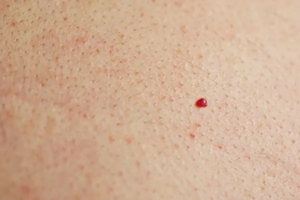 close up of a cherry angioma Ruislip Manor
