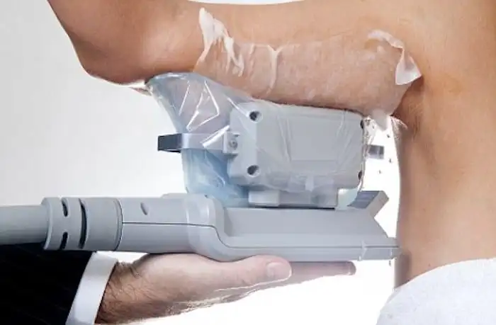 Picture of fat freezing Ruislip Manor on the upper arms.