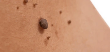 image of a skin tag Ruislip Manor