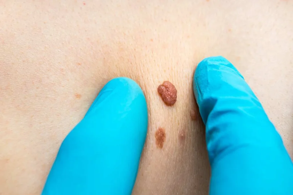 Consultant examining a skin tag Ruislip Manor