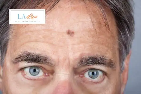 Solar Lentigo Removal Ruislip Manor image of man with mark on his forehead