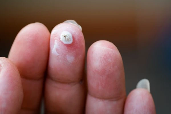 wart on person finger - cryotherapy to treat from LA LIPO Ruislip Manor
