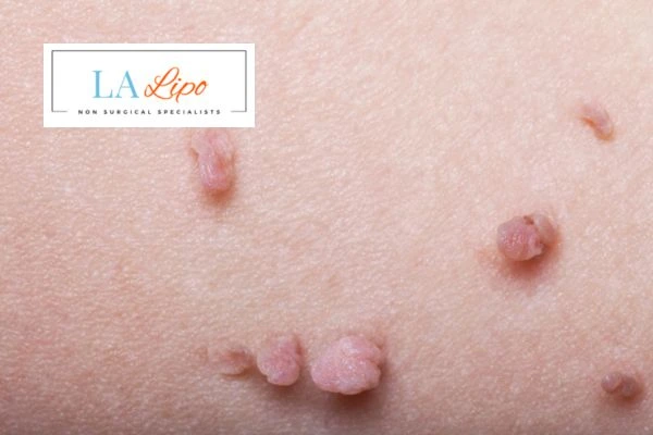 Does cryopen skin tag removal Ruislip Manor hurt? Find out now call our team today!
