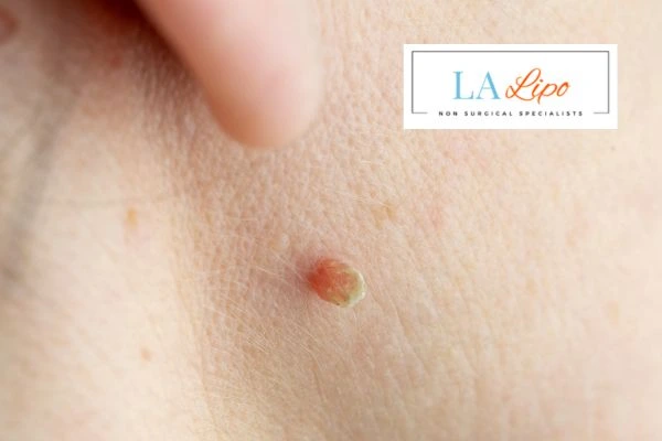 Book skin tag removal Ruislip Manor today speak to our team now!