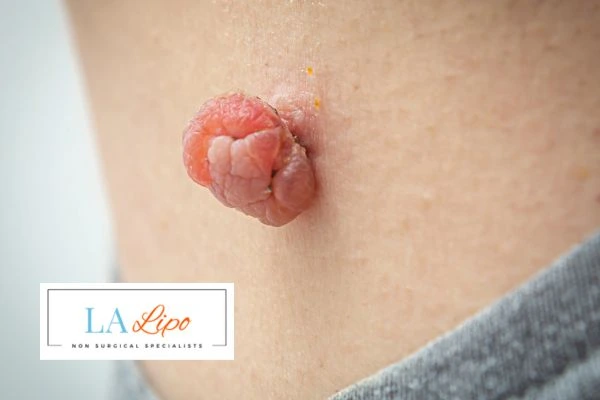 Interested in skin tag removal Ruislip Manor? Concerned about the pain? Find out more today!