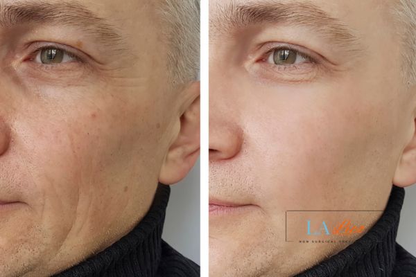 See the amazing results of Morpheus8 Treatment Ruislip Manor!