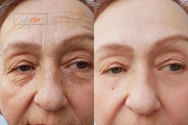The powerful benefits of Morpheus8 Treatment Ruislip Manor - Call Our team today!