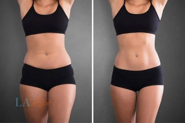 before and after results of non-surgical treatment to help a woman's body image and mental health Ruislip Manor