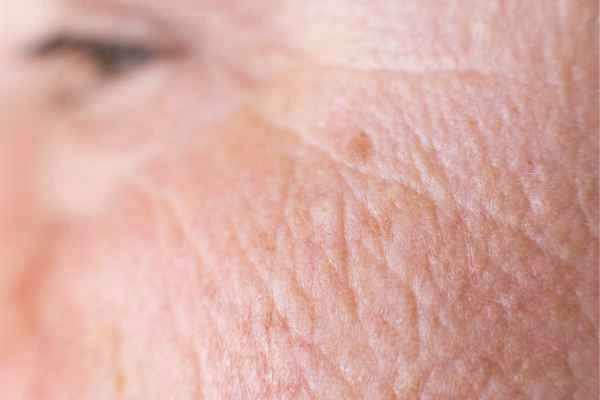 close up picture of a woman's face showing an age spot Ruislip Manor