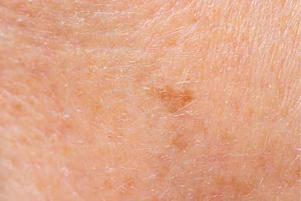 close up picture of age spots Ruislip Manor