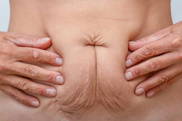 Should I Combine Diastasis Recti Treatment with Body Contouring for Better Results Ruislip Manor?