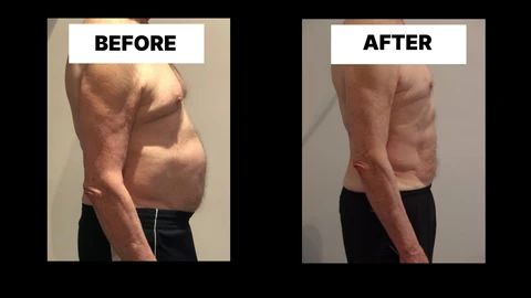 What Symptoms Can Diastasis Recti Cause in Men? Weak Core, Back Pain and Poor Posture Ruislip Manor